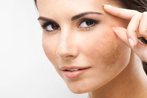 Pigmentation Treatment Pigmentation