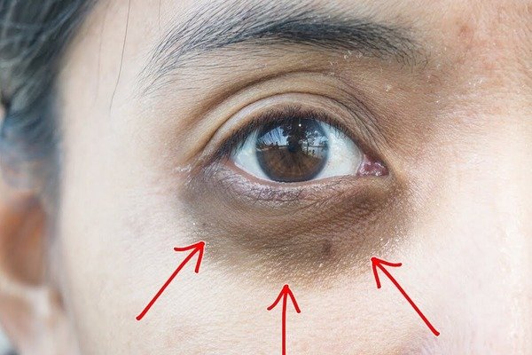 UNDER EYE DARKNESS UNDER EYE DARKNESS