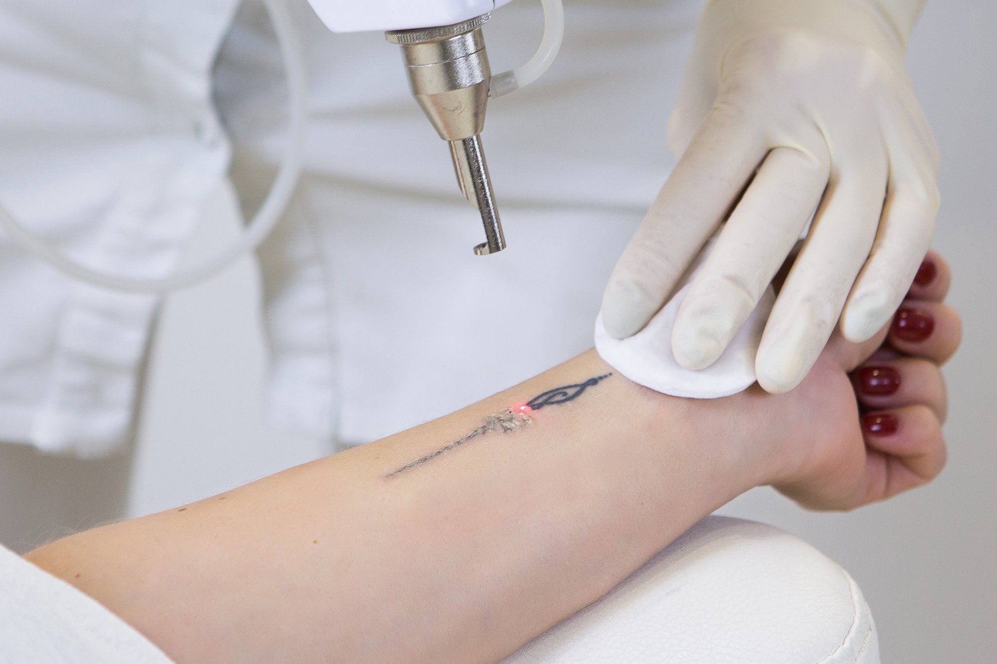 how-does-laser-tattoo-removal-work how-does-laser-tattoo-removal-work
