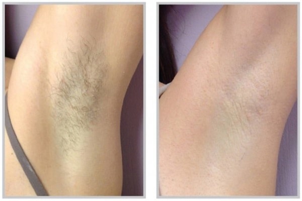 Before And After