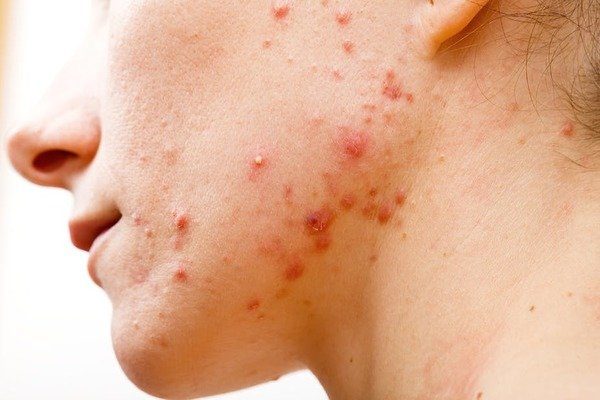Acne Acne Clinic -ASC