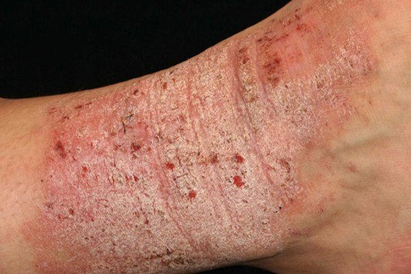 Eczema Eczema