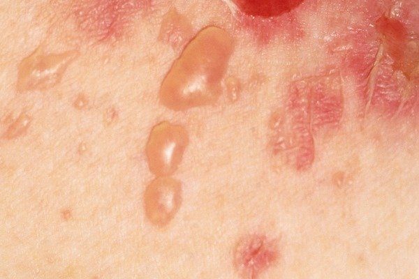 pemphigus vulgaris pemphigus vulgaris