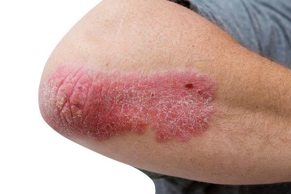 psoriasis on a mid age mans elbow Psoriasis