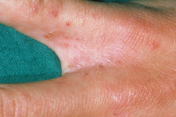 Scabies Scabies
