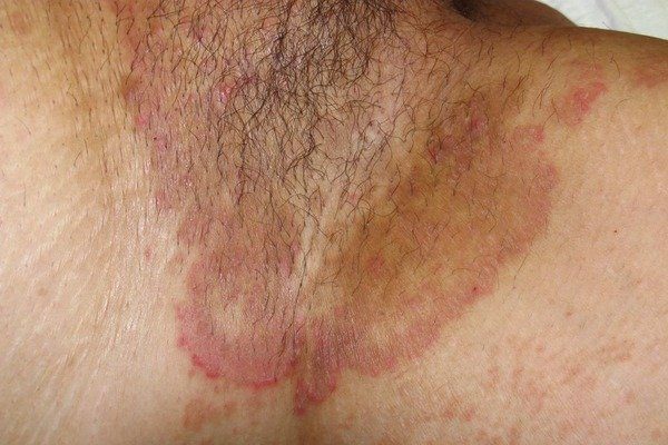 Tinea Tinea