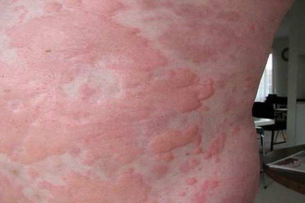 Urticaria