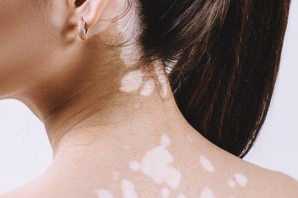Vitiligo Vitiligo
