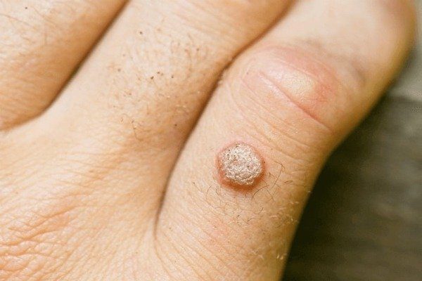Wart Wart